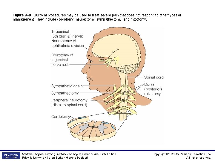 Figure 9– 8 Surgical procedures may be used to treat severe pain that does