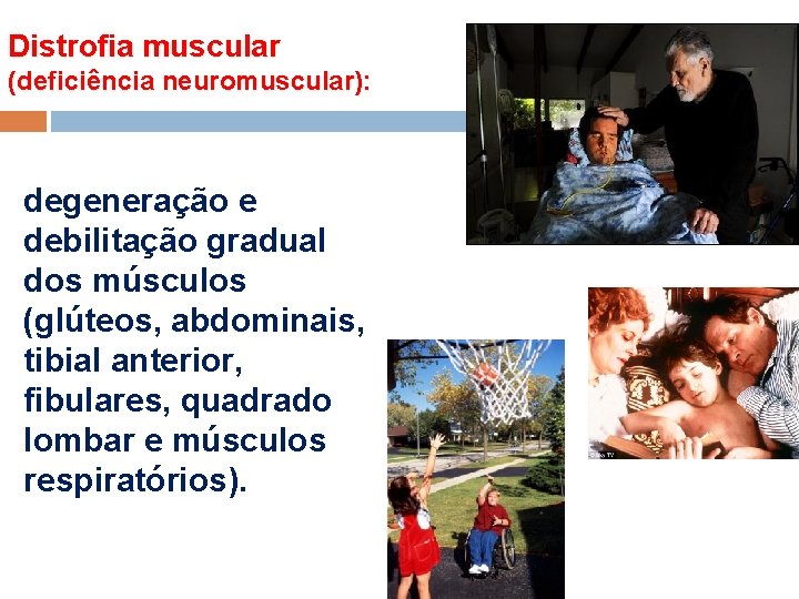 Distrofia muscular (deficiência neuromuscular): degeneração e debilitação gradual dos músculos (glúteos, abdominais, tibial anterior,