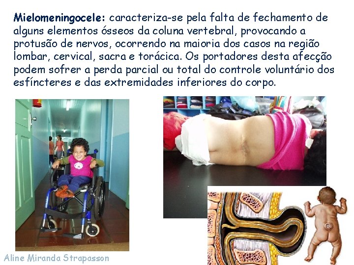 Mielomeningocele: caracteriza-se pela falta de fechamento de alguns elementos ósseos da coluna vertebral, provocando