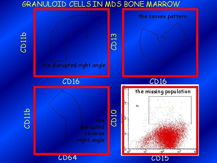 GRANULOID CELLS IN MDS BONE MARROW CD 13 CD 11 b the convex pattern