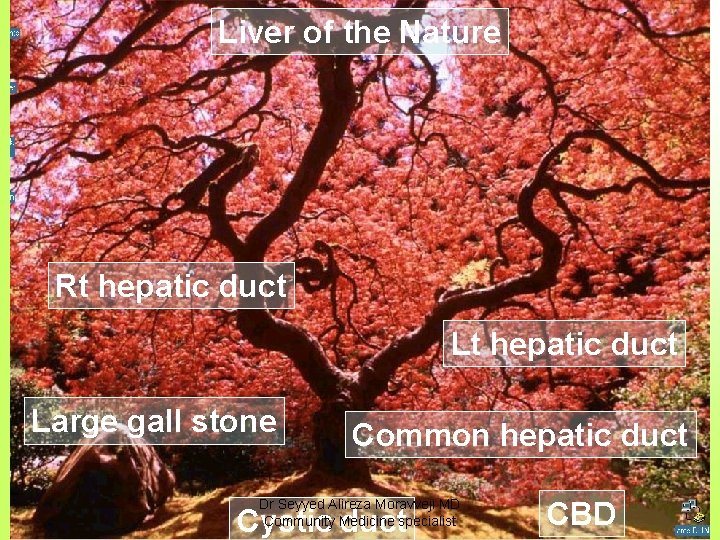Liver of the Nature Rt hepatic duct Large gall stone Common hepatic duct Dr