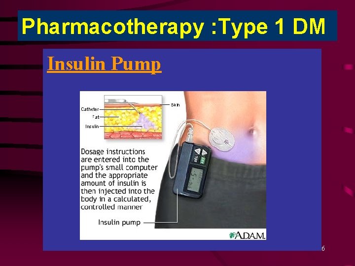 Pharmacotherapy : Type 1 DM Insulin Pump 86 