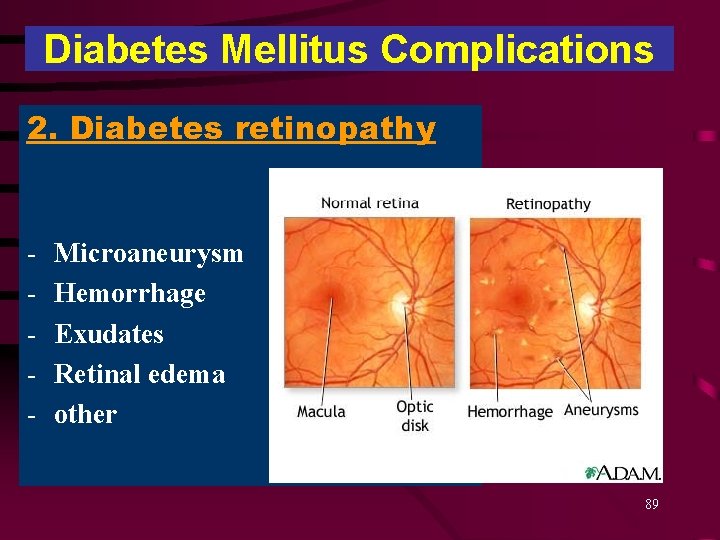 Diabetes Mellitus Complications 2. Diabetes retinopathy - Microaneurysm Hemorrhage Exudates Retinal edema other 89