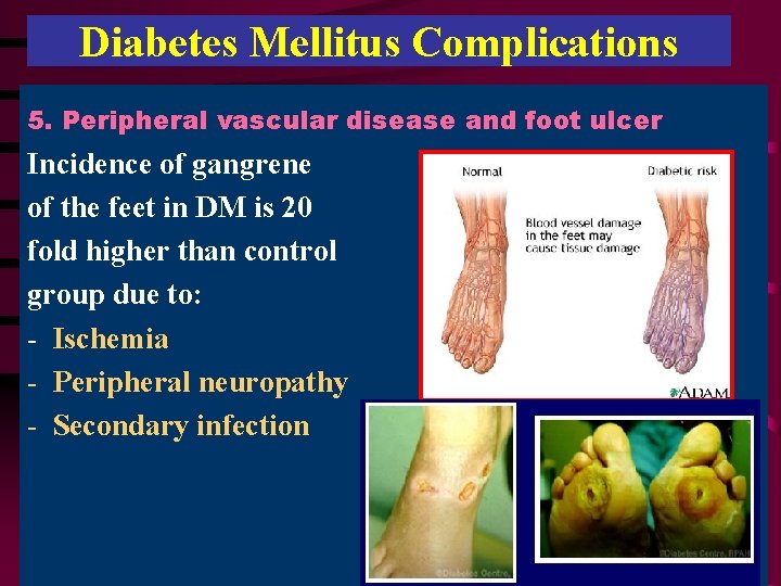 Diabetes Mellitus Complications 5. Peripheral vascular disease and foot ulcer Incidence of gangrene of