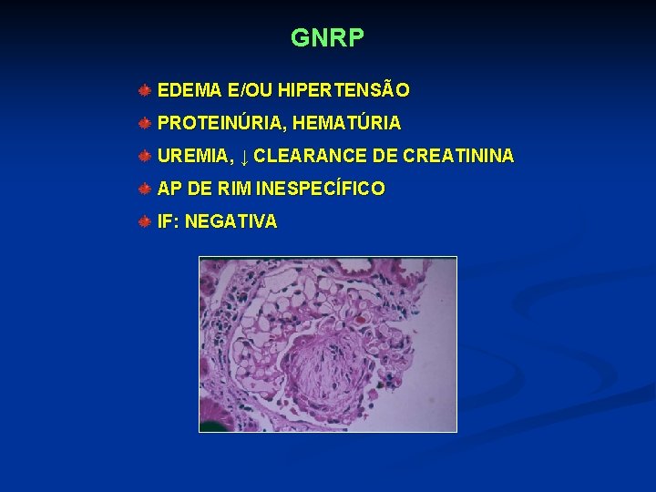 GNRP EDEMA E/OU HIPERTENSÃO PROTEINÚRIA, HEMATÚRIA UREMIA, ↓ CLEARANCE DE CREATININA AP DE RIM