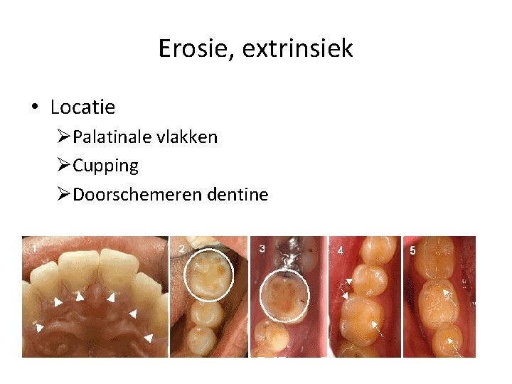 Erosie, extrinsiek • Locatie ØPalatinale vlakken ØCupping ØDoorschemeren dentine 