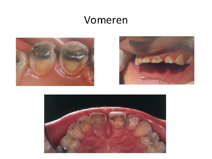 Vomeren 