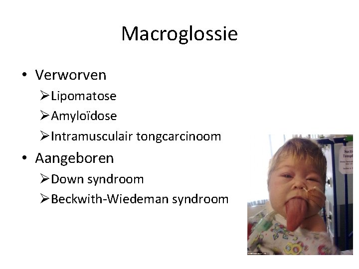 Macroglossie • Verworven ØLipomatose ØAmyloïdose ØIntramusculair tongcarcinoom • Aangeboren ØDown syndroom ØBeckwith-Wiedeman syndroom 