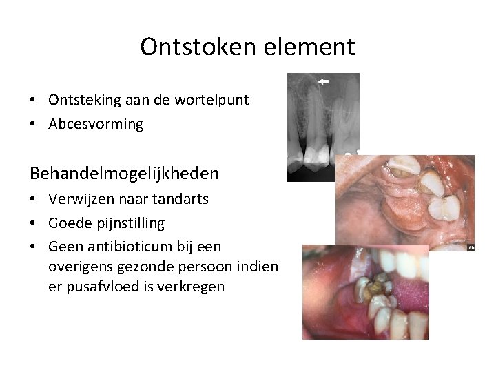 Ontstoken element • Ontsteking aan de wortelpunt • Abcesvorming Behandelmogelijkheden • Verwijzen naar tandarts