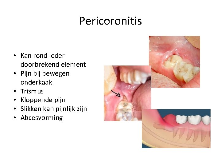 Pericoronitis • Kan rond ieder doorbrekend element • Pijn bij bewegen onderkaak • Trismus