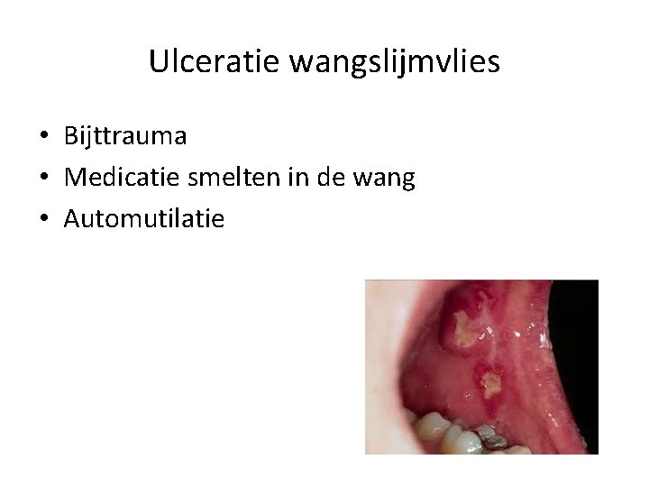 Ulceratie wangslijmvlies • Bijttrauma • Medicatie smelten in de wang • Automutilatie 