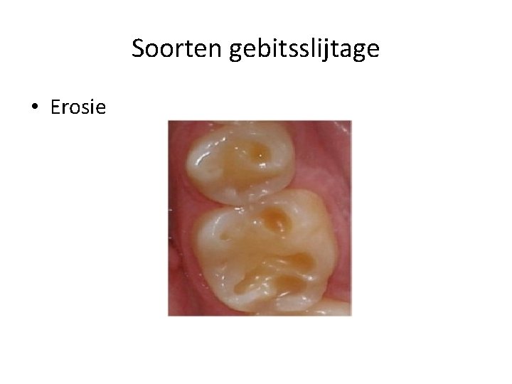 Soorten gebitsslijtage • Erosie 