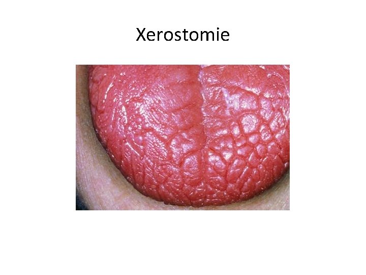 Xerostomie 