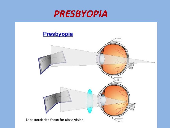 PRESBYOPIA 