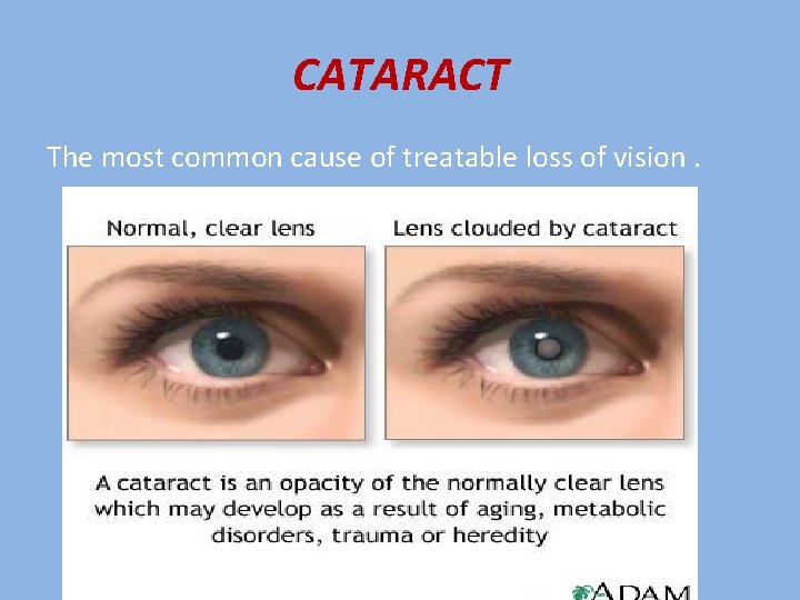 CATARACT The most common cause of treatable loss of vision. 