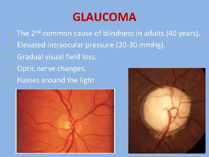 GLAUCOMA § § § The 2 nd common cause of blindness in adults (40