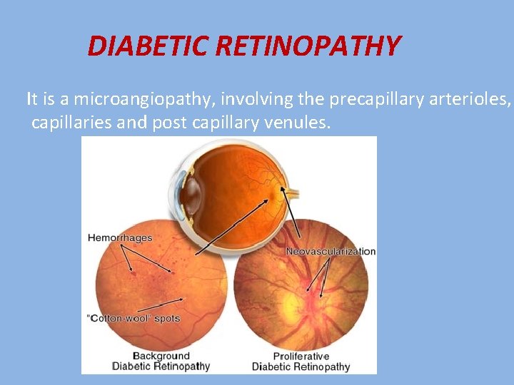 DIABETIC RETINOPATHY It is a microangiopathy, involving the precapillary arterioles, capillaries and post capillary