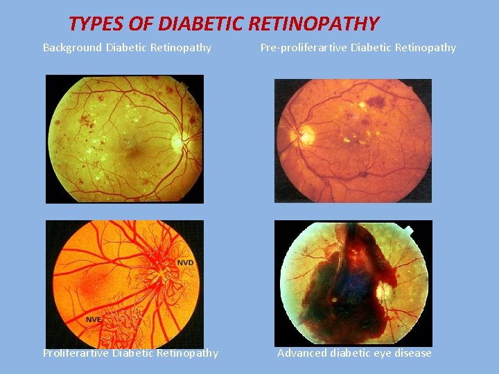 TYPES OF DIABETIC RETINOPATHY Background Diabetic Retinopathy Pre-proliferartive Diabetic Retinopathy Proliferartive Diabetic Retinopathy Advanced