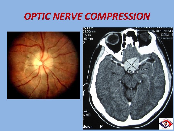 OPTIC NERVE COMPRESSION 