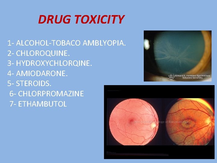 DRUG TOXICITY 1 - ALCOHOL-TOBACO AMBLYOPIA. 2 - CHLOROQUINE. 3 - HYDROXYCHLORQINE. 4 -