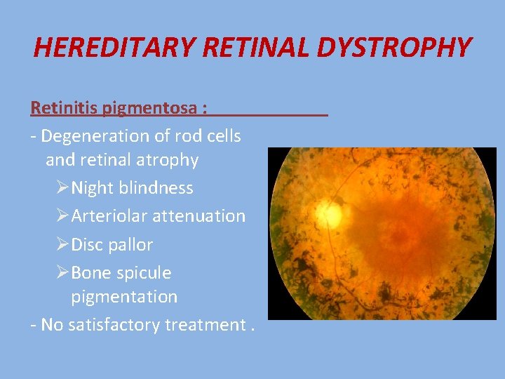 HEREDITARY RETINAL DYSTROPHY Retinitis pigmentosa : - Degeneration of rod cells and retinal atrophy