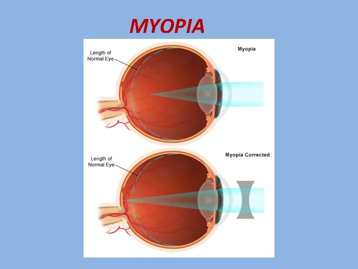 MYOPIA 