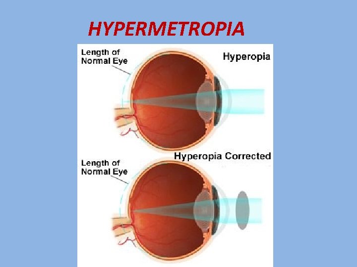 HYPERMETROPIA 