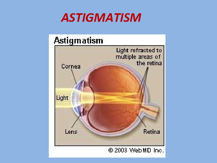 ASTIGMATISM 