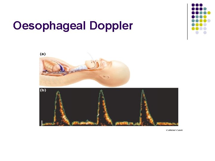 Oesophageal Doppler 