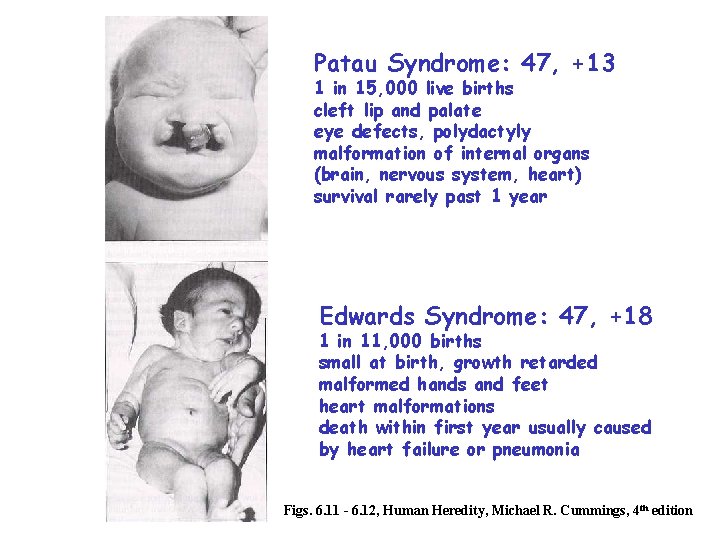 Patau Syndrome: 47, +13 1 in 15, 000 live births cleft lip and palate