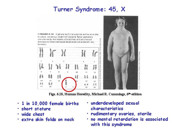Turner Syndrome: 45, X Figs. 6. 18, Human Heredity, Michael R. Cummings, 6 th