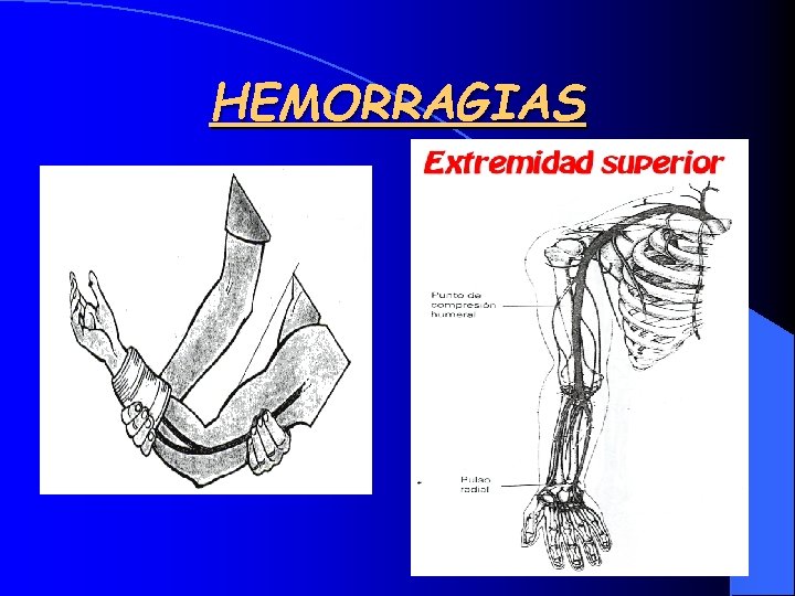 HEMORRAGIAS 