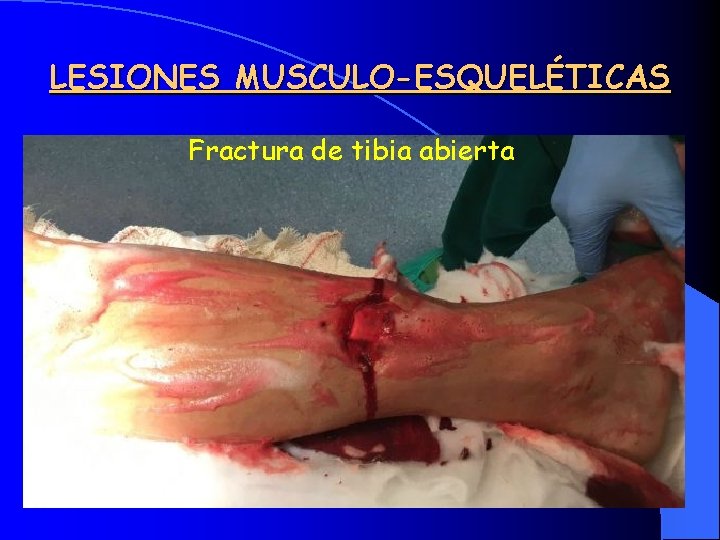 LESIONES MUSCULO-ESQUELÉTICAS Fractura de tibia abierta 