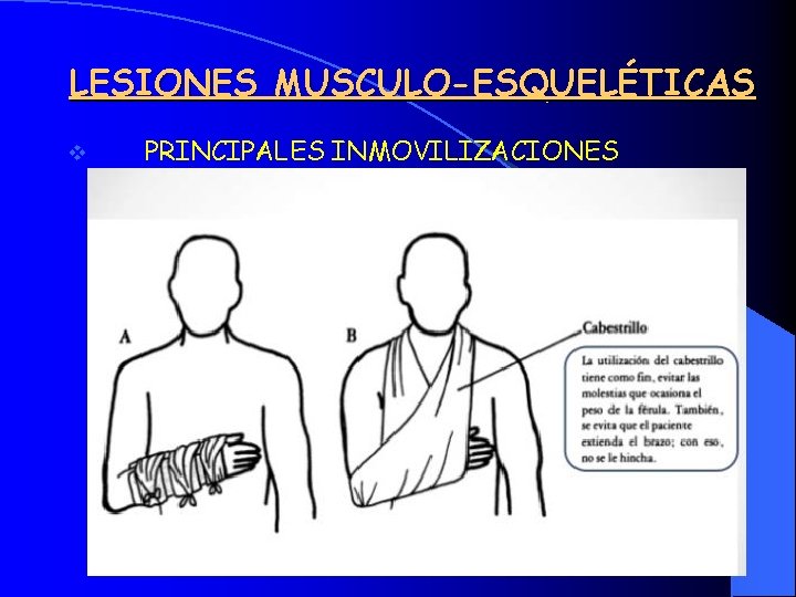 LESIONES MUSCULO-ESQUELÉTICAS v PRINCIPALES INMOVILIZACIONES 