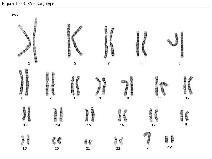 Figure 15. x 3 XYY karyotype 