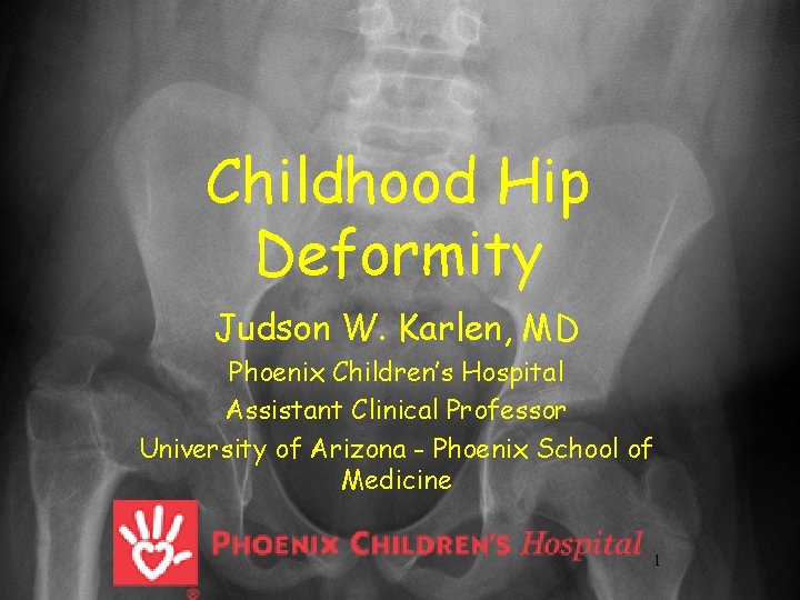 Childhood Hip Deformity Judson W. Karlen, MD Phoenix Children’s Hospital Assistant Clinical Professor University