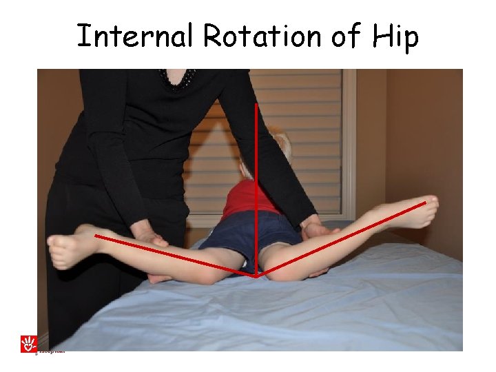 Internal Rotation of Hip 