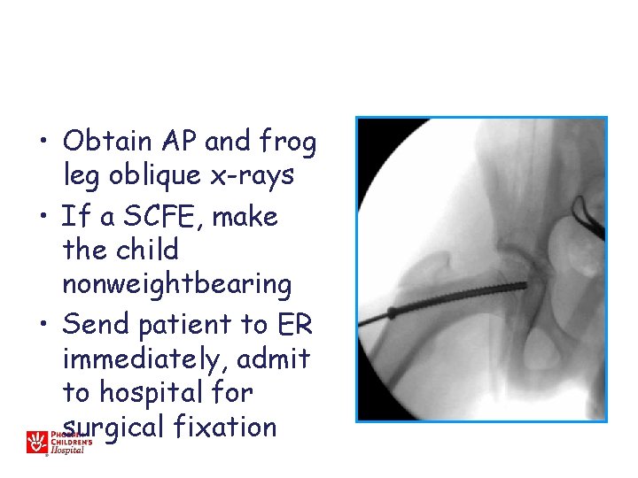  • Obtain AP and frog leg oblique x-rays • If a SCFE, make