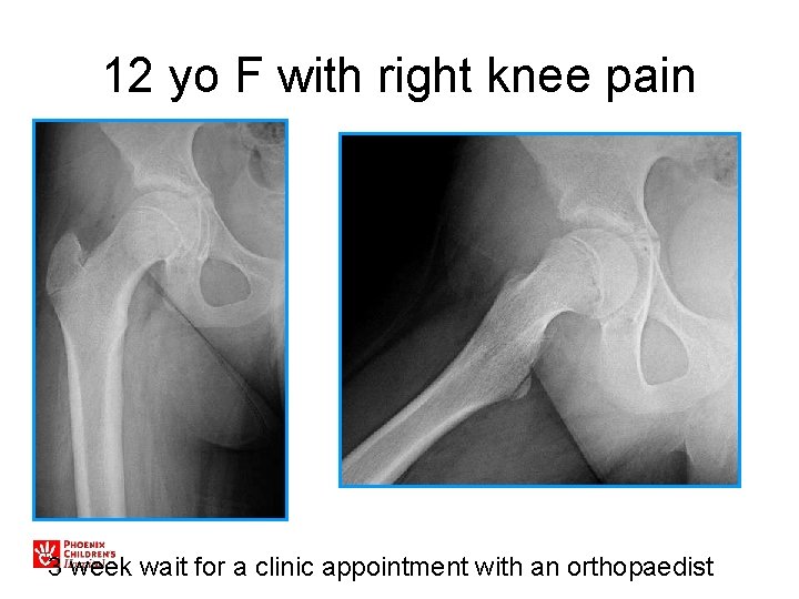 12 yo F with right knee pain 3 week wait for a clinic appointment