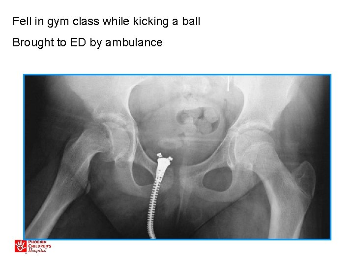 Fell in gym class while kicking a ball Brought to ED by ambulance 