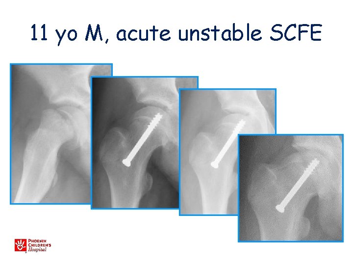 11 yo M, acute unstable SCFE 