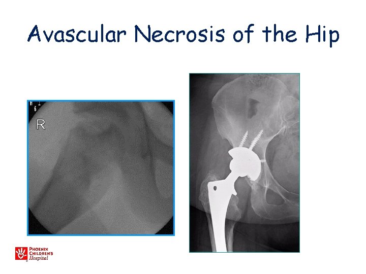 Avascular Necrosis of the Hip 