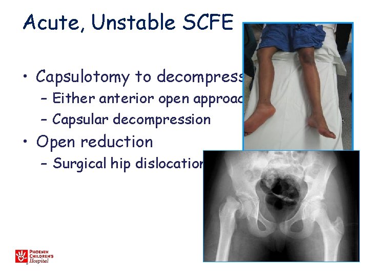 Acute, Unstable SCFE • Capsulotomy to decompress – Either anterior open approach – Capsular