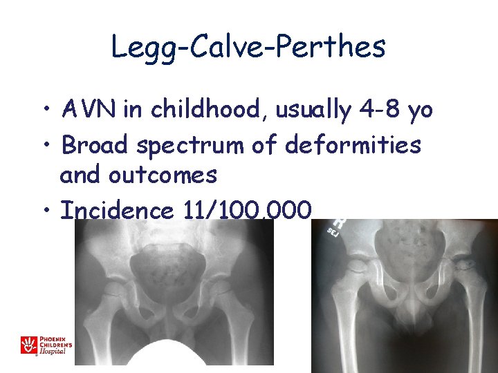 Legg-Calve-Perthes • AVN in childhood, usually 4 -8 yo • Broad spectrum of deformities