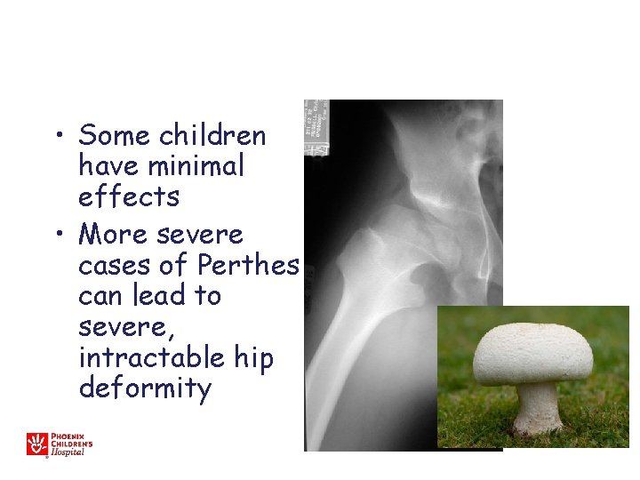  • Some children have minimal effects • More severe cases of Perthes can