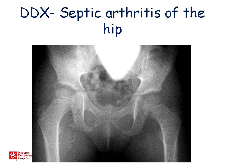 DDX- Septic arthritis of the hip 