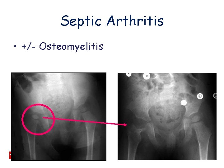 Septic Arthritis • +/- Osteomyelitis 