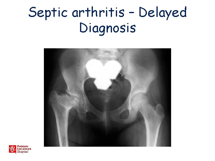 Septic arthritis – Delayed Diagnosis 