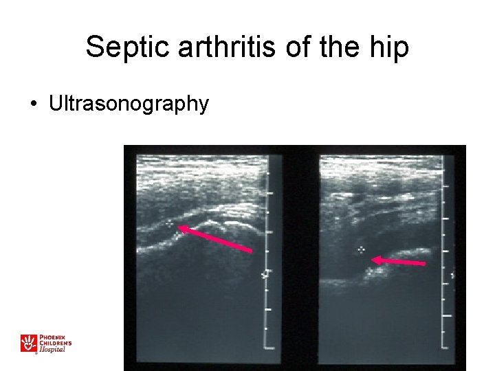 Septic arthritis of the hip • Ultrasonography 