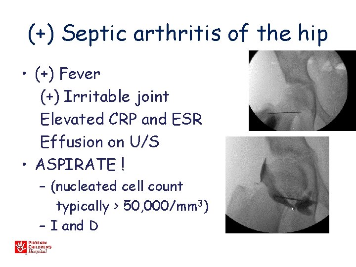 (+) Septic arthritis of the hip • (+) Fever (+) Irritable joint Elevated CRP